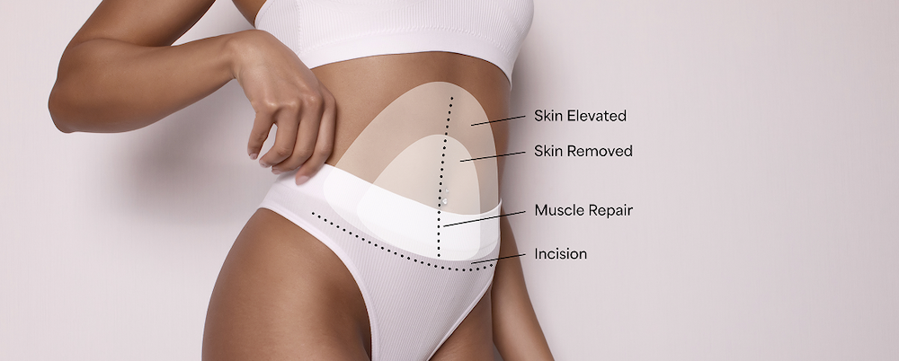Diagram of a tummy tuck procedure showing skin elevated, skin removed, muscle repair, and incision line.