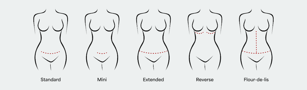 Diagram showing the five main types of tummy tuck incisions: Standard, Mini, Extended, Reverse, and Fleur-de-lis abdominoplasty.